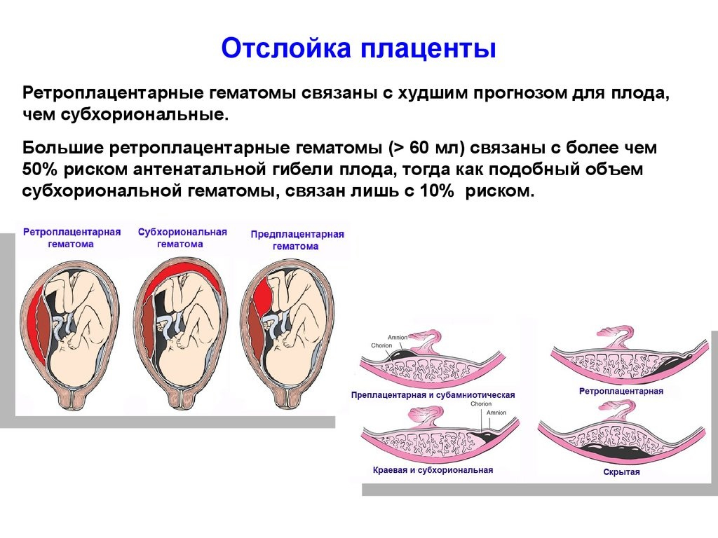 отслойка плаценты на поздних сроках беременности